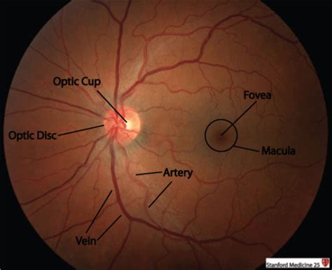 fundoscopy findings